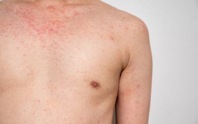 Private dermatology Kent