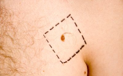 Mole removal surgery Kent