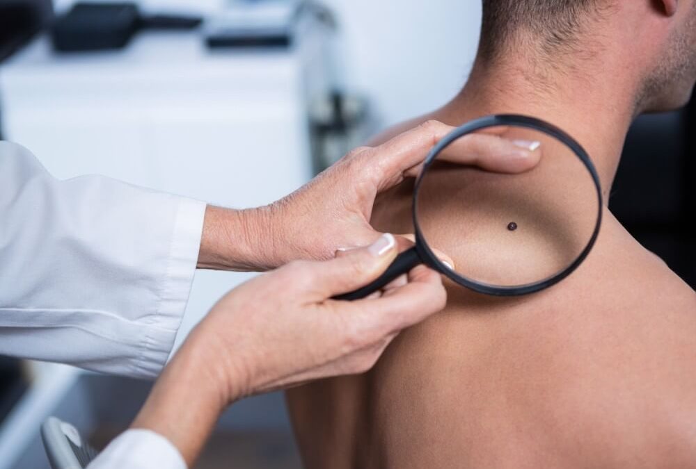 Mole mapping Kent: total body photography