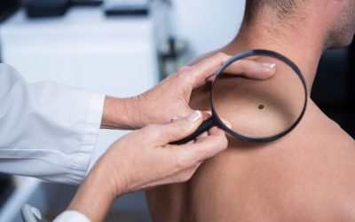 Mole mapping Kent: total body photography